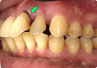 歯周病による歯の病的移動