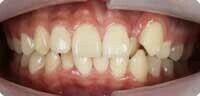 前歯クロスバイトの弊害
