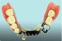 チタン床金属義歯（部分入れ歯）