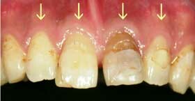 術前で虫歯、歯の変色、歯列不正が見られる