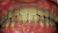テトラサイクリンによる重度の変色歯