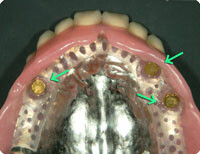 インプラントを利用したマグネット式アタッチメント義歯