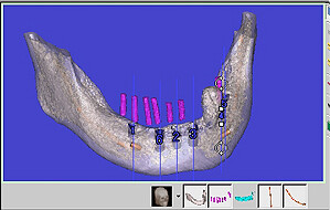 下顎に数本インプラントを埋入した時のシミュレーション