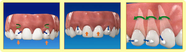 上顎切歯のコントロール性の向上