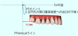 上顎大臼歯の遠心移動限界