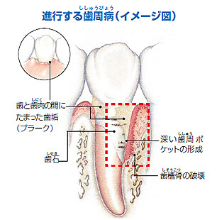 進行する歯周病