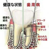 歯周病の模式図
