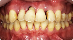 歯周炎の特徴