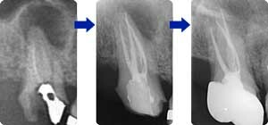 根の先に大きなレントゲン影がある歯の根管治療