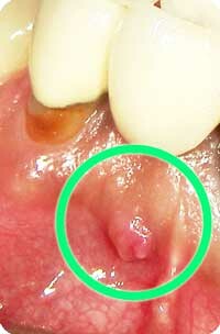 サイナストラクト(瘻孔、フィステル)は根尖病変から歯肉への膿の出口