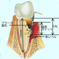 歯周組織の損失