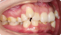 八重歯の矯正治療