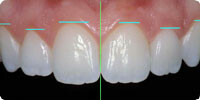 審美歯科の基準