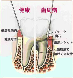 歯周病による組織の喪失