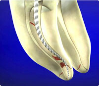 歯内療法の三種の神器のひとつ「NiTiファイル」