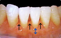 歯周病による歯肉の退縮