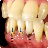 歯石により歯根が露出する