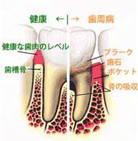 奥歯の歯周病