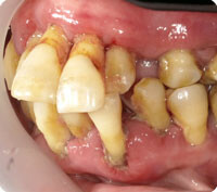 重度歯周病の症状