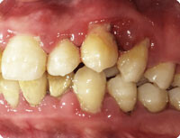歯周病を増悪する要因