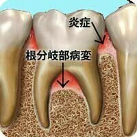 歯周病によって引き起こされた根分岐部病変