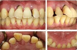 歯周病による病的歯牙移動