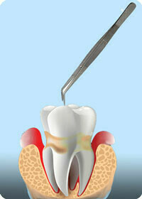 歯周病の動揺度検査